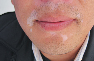 武汉白癜风专科医院在哪