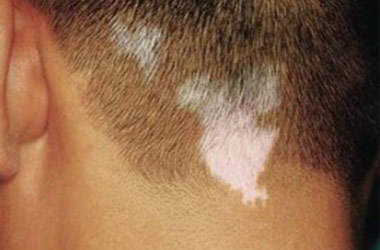 荆州白癜风医院