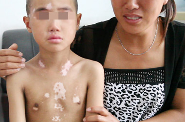 十堰治疗白癜好医院?不定期的治疗儿童白癜风会怎么样?