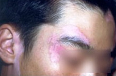 咸宁专业治疗白癜风医院?科学预防白癜风生活中要注意啥?