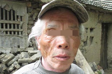 鄂州哪个医院治疗白癜风病好？肝功能异常对白癜风患者有哪些危害呢?