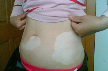 白癜风医生讲解孕妇可以吃药治疗白癜风吗?