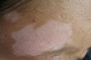 有治疗局限型白癜风的医院吗?