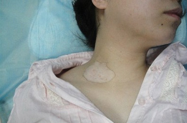 咸宁治疗白癜风医院讲述背部白癜风症状?