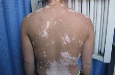 不在背上的白斑可以用刮痧治疗吗?