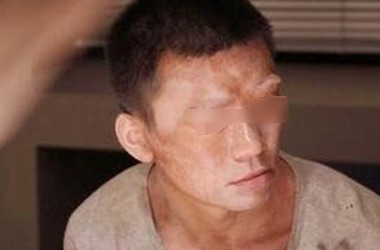 鄂州男性脸部白癜风的病因有哪些