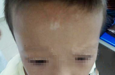 黄冈白癜风医院