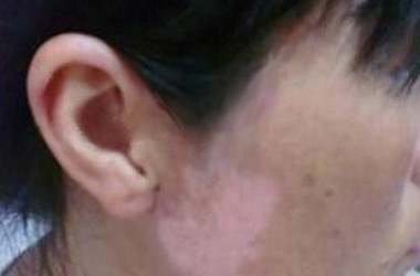 导致女性患白癜风的原因是什么呢?