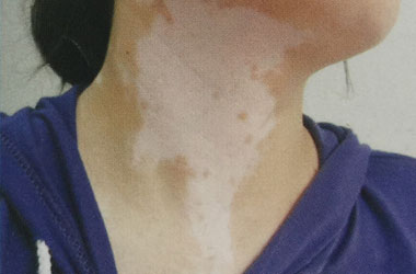 脖子处的白癜风是什么原因?