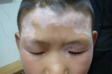 如何防止白癜风的发生呢?
