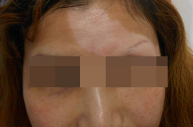 女性白癜风患者如何调节感情?