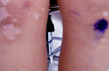 腿部白癜风的病因是什么呢?