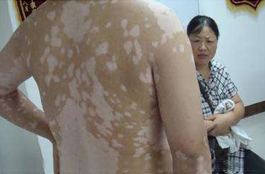 夏季游泳男性白癜风患者的注意事项有哪些?