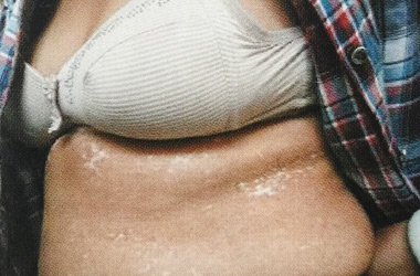 孝感如何诊断胸部白癜风呢?