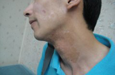 男性在白癜风治疗过程中应注意什么?