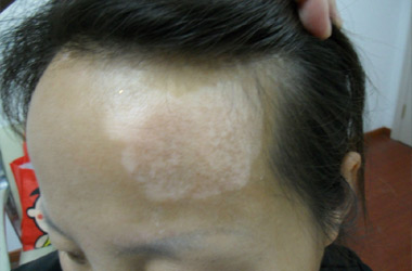 女性长白癜风的原因都有哪几种?