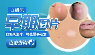 鄂州医院医生介绍刚开始患白癜风时有哪些症状?