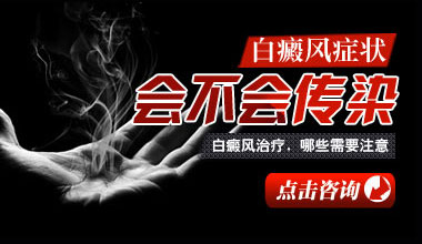 鄂州医院医生都不一定的知道的,治疗白癜风小常识