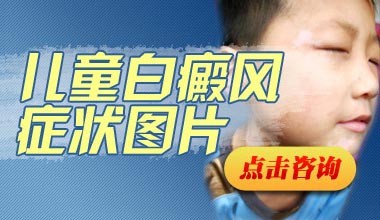 鄂州儿童白癜风白斑初期症状图什么样