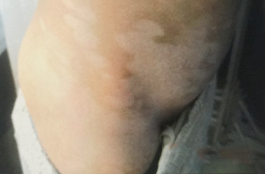 男性生殖器长白点是什么原因?