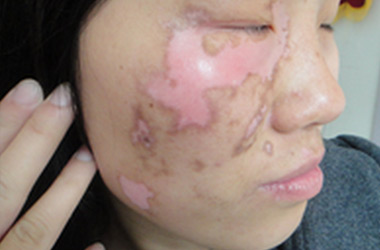 咸宁白斑患者用308治疗白癜风可以中断吗?