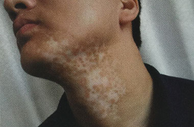 孝感白癜风患者如何治疗才能减少危害呢?