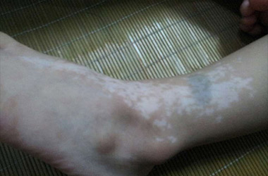 脚部白癜风擦药疗**如何?