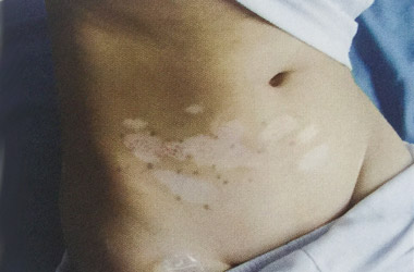 男性生殖器长白斑可以照308激光吗?