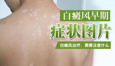 咸宁医院医生介绍白癜风的早期症状