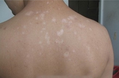 咸宁白癜风殷医生介绍治疗白癜风较好的方法