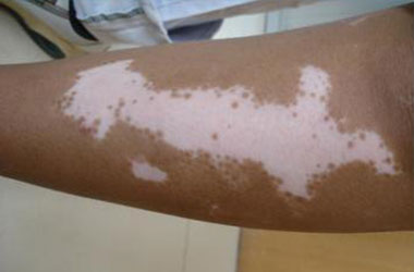 节段性白癜风患者用什么药?
