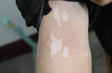 引起手臂白癜风的原因是什么?