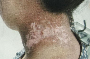 鄂州白癜风患者治疗应该遵循什么原则