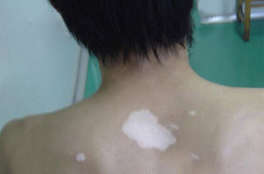 白癜风的白斑对患者有哪些危害?
