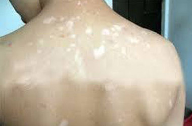 如何治疗白癜风会更好呢?