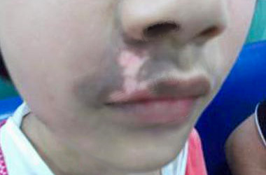孩子患白癜风时应该注意些什么?