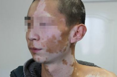 白癜风对男性病人有哪些伤害?