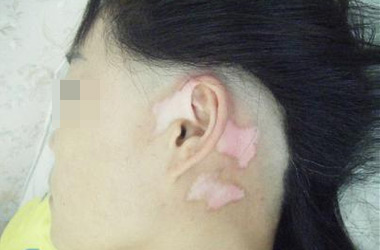 随州白癜风医院