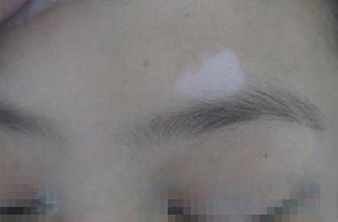 局限性白癜风的病因都是什么?