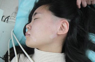 女性得白癜风病的原因是什么?