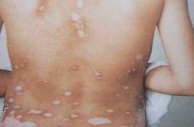 背上的白癜风擦复方卡然酊治疗后，患处起水泡了怎么办?
